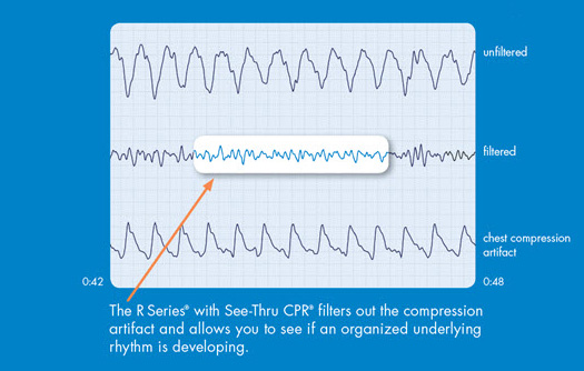 See-thru Cardiopulmonary Resuscitation (CPR) waveform